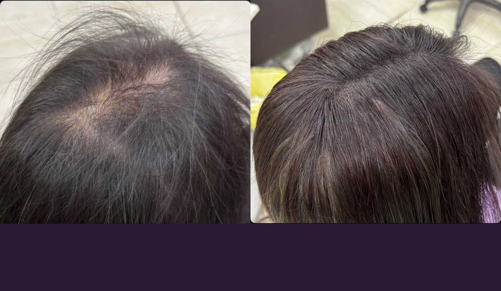Antes e depois de aplicação de topo capilar com cabelo humano no Studio Rejane Belíssima